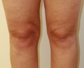 Feel Beautiful - Liposuction Case 7 - After Photo